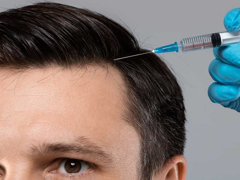 Microinyección de mesoterapia capilar en la línea frontal del cuero cabelludo de un paciente