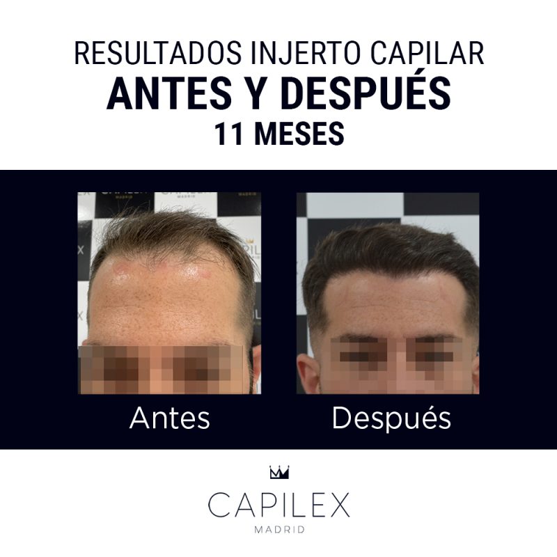 Comparativa del antes y el después de un injerto capilar realizado en Clínica Capilex Madrid