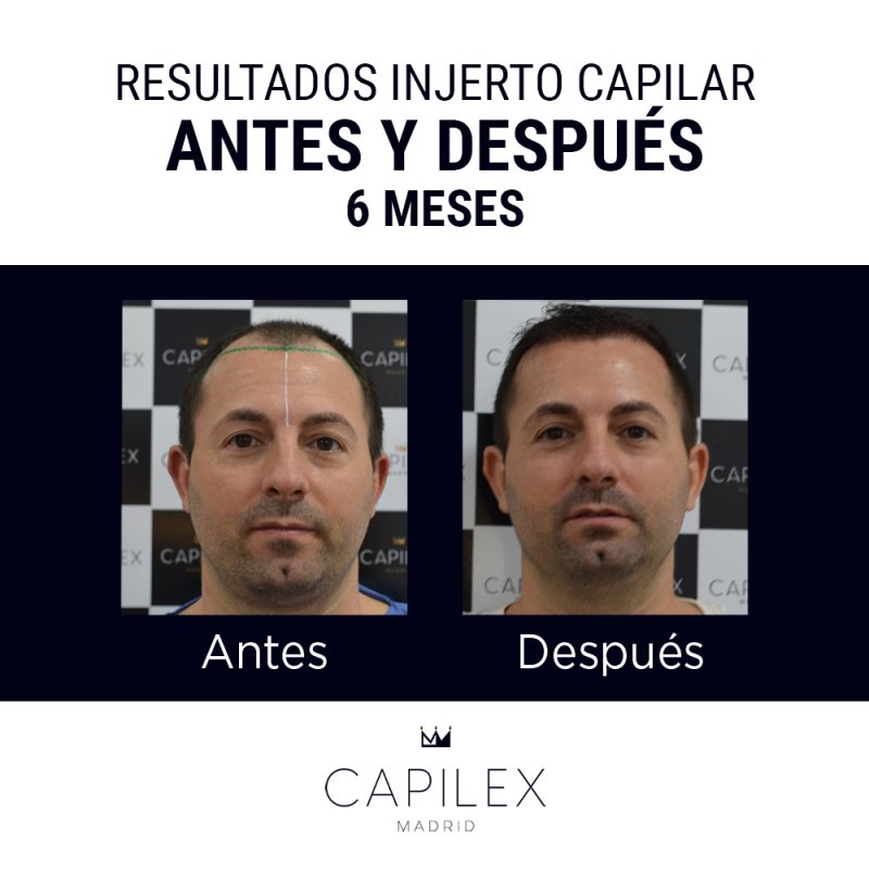 Comparativa del antes y el después de un injerto capilar realizado en Clínica Capilex Madrid