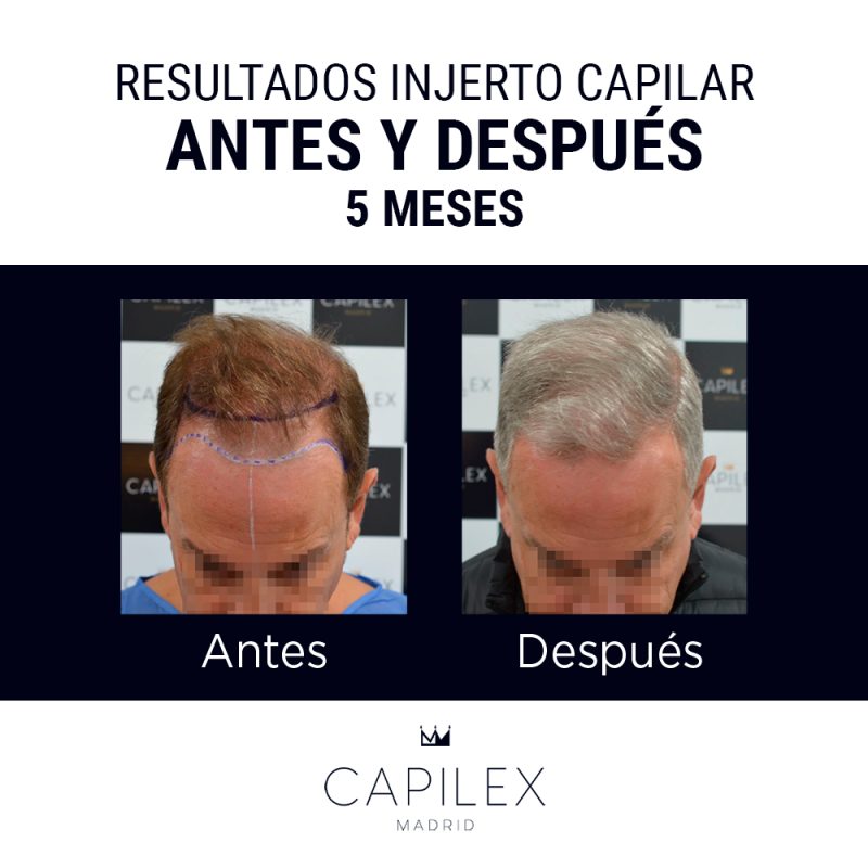 Comparativa del antes y el después de un injerto capilar realizado en Clínica Capilex Madrid