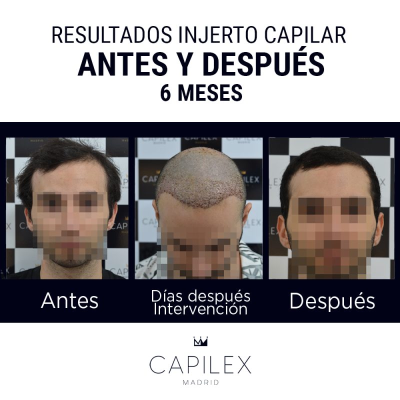Comparativa del antes y el después de un injerto capilar realizado en Clínica Capilex Madrid