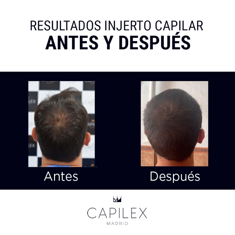Comparativa del antes y el después de un injerto capilar realizado en Clínica Capilex Madrid