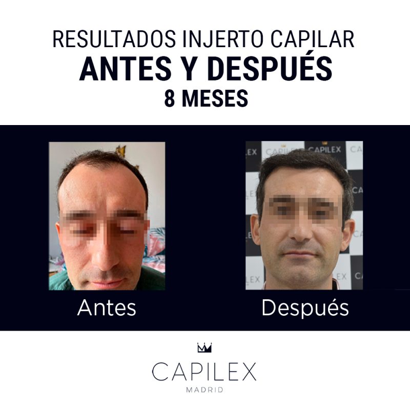 Comparativa del antes y el después de un injerto capilar realizado en Clínica Capilex Madrid