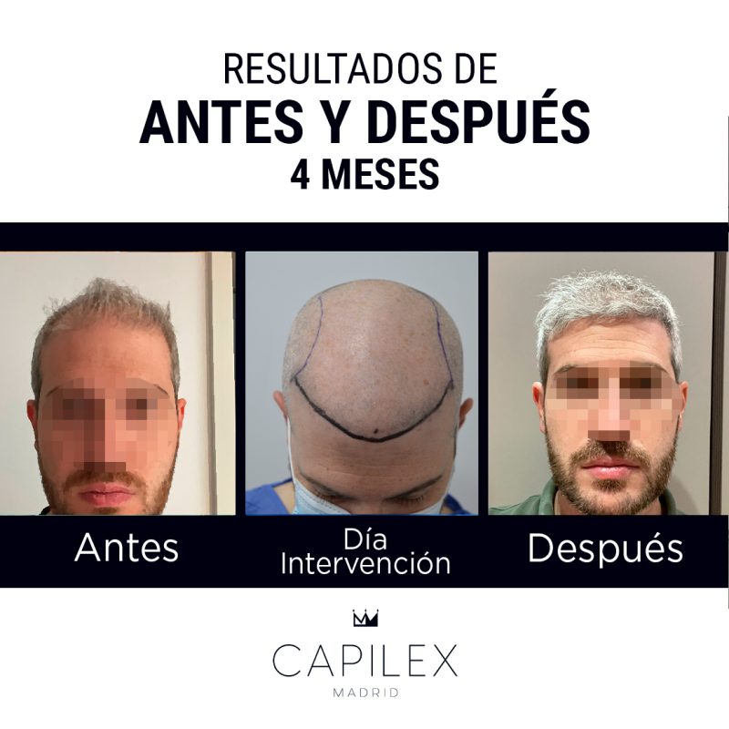 Comparativa del antes y el después de un injerto capilar realizado en Clínica Capilex Madrid