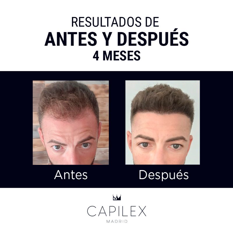 Comparativa del antes y el después de un injerto capilar realizado en Clínica Capilex Madrid