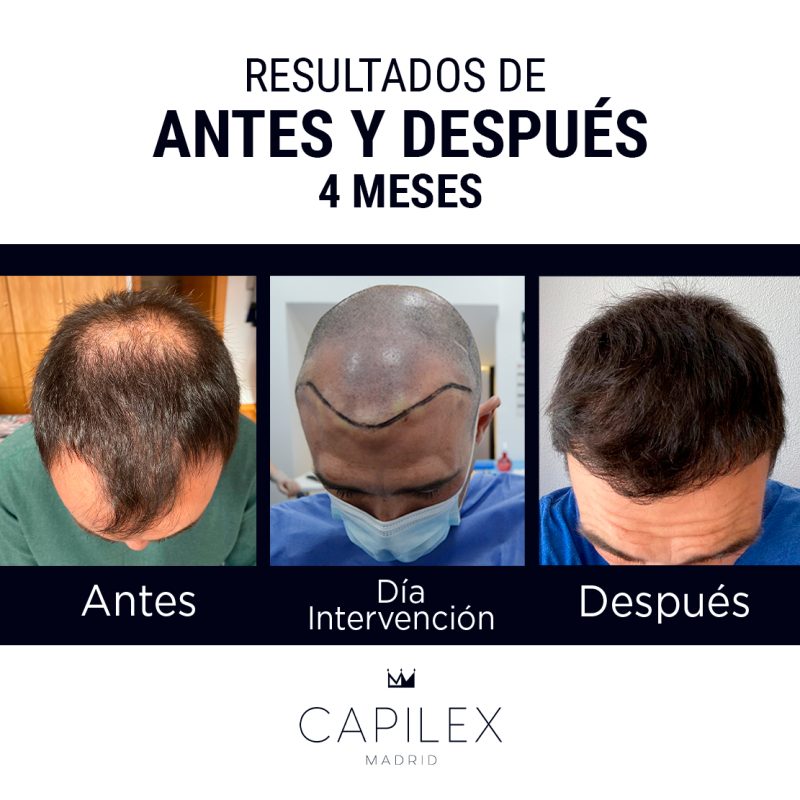 Comparativa del antes y el después de un injerto capilar realizado en Clínica Capilex Madrid